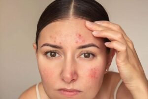 Cách dùng serum trị mụn đúng