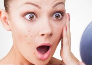Serum trị mụn hỗ trọ giảm mụn