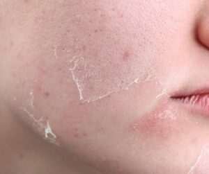 Serum phục hồi dùng đúng cách